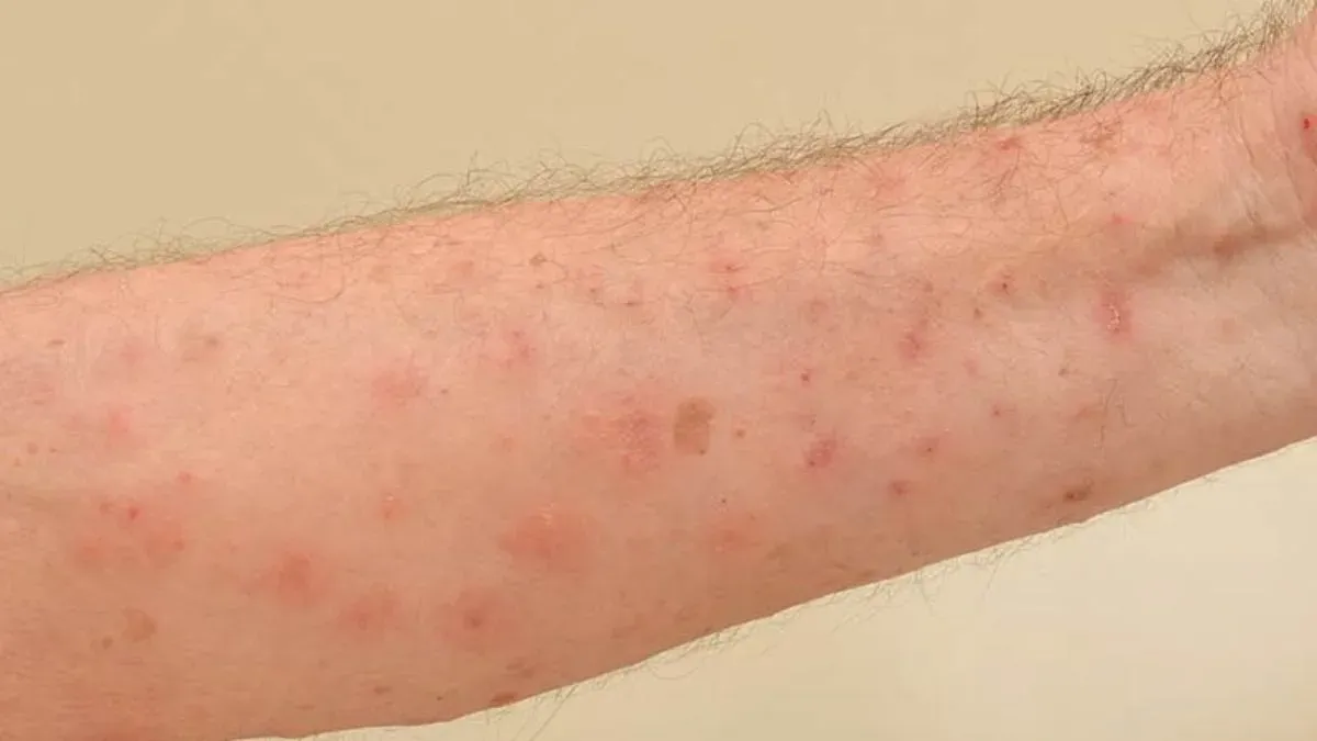 scabies
