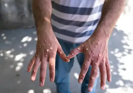 india monkey pox