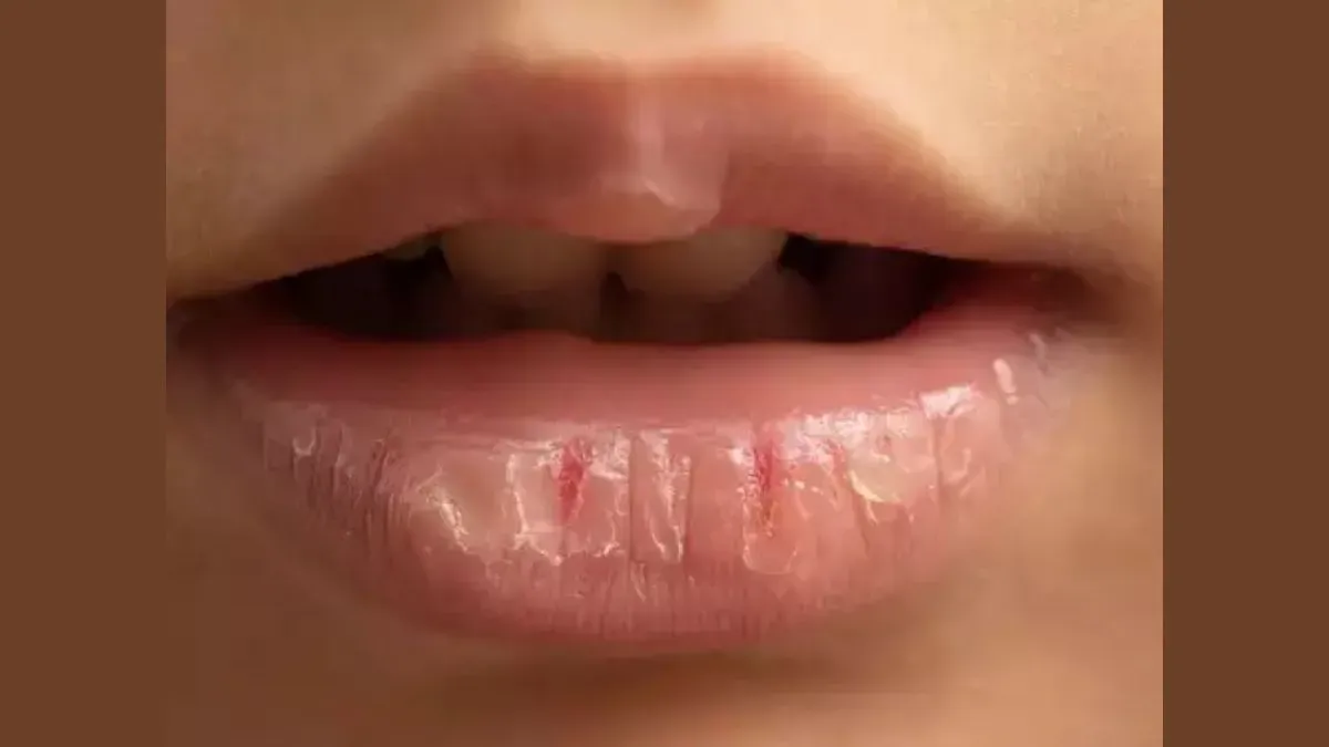 dry lips