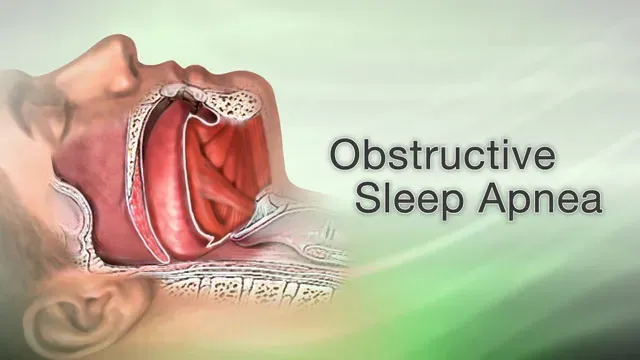 Sleep Apnea