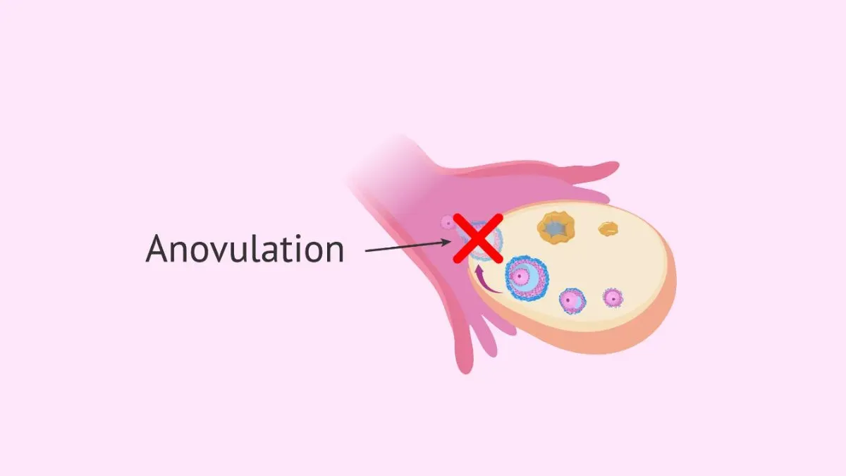 anovulation