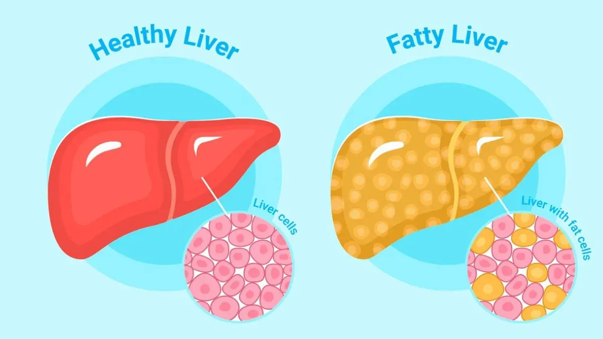 fatty liver