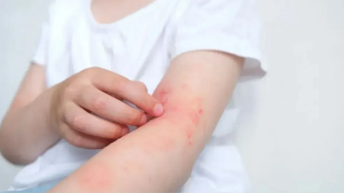 food allergy