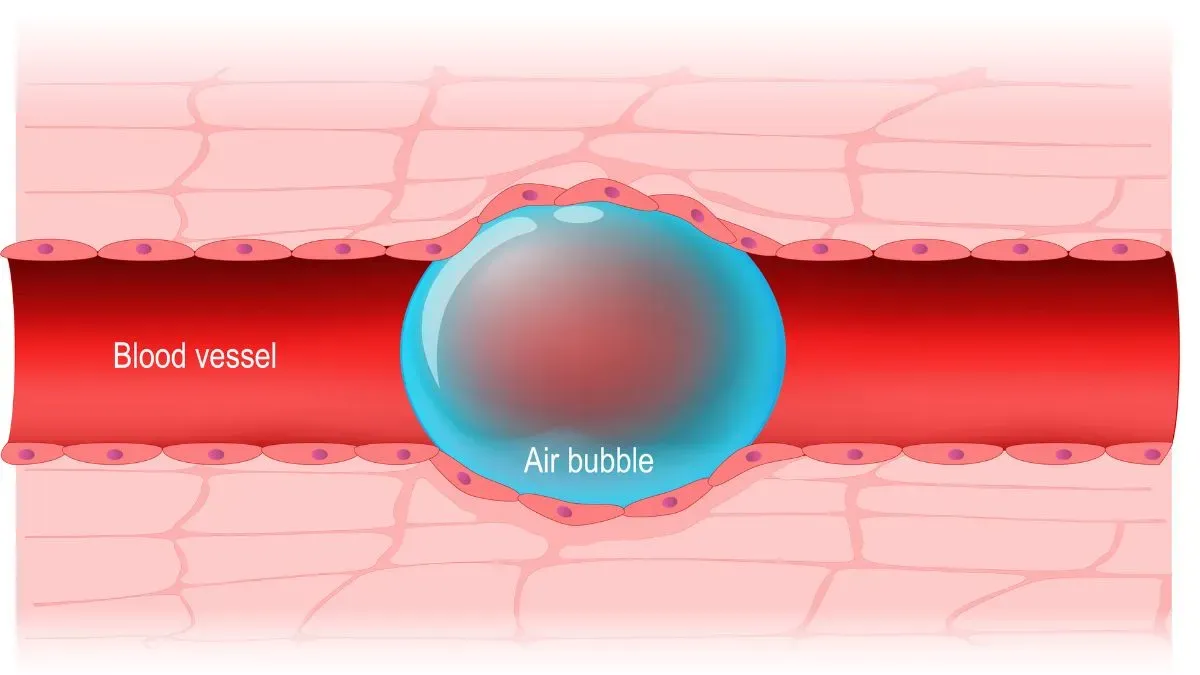 air embolism