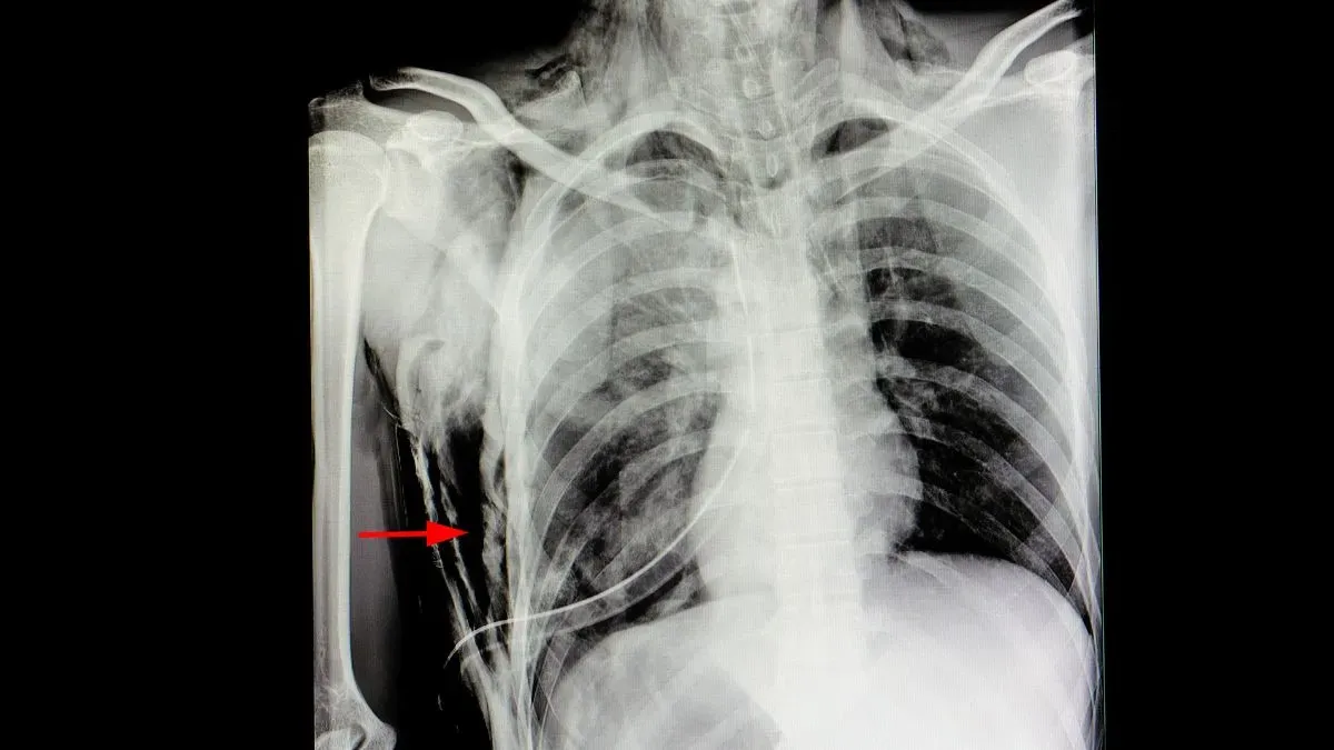 subcutaneous emphysema