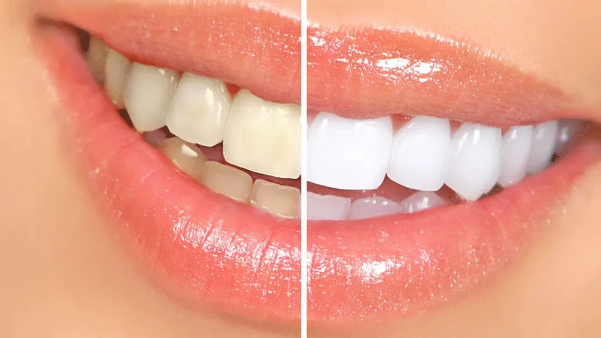 teeth whitening