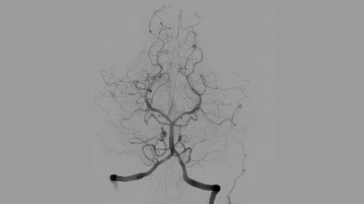 angiography