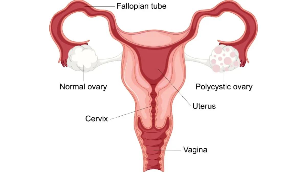 pcos