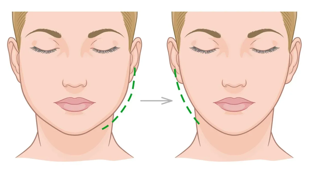 buccal fat removal