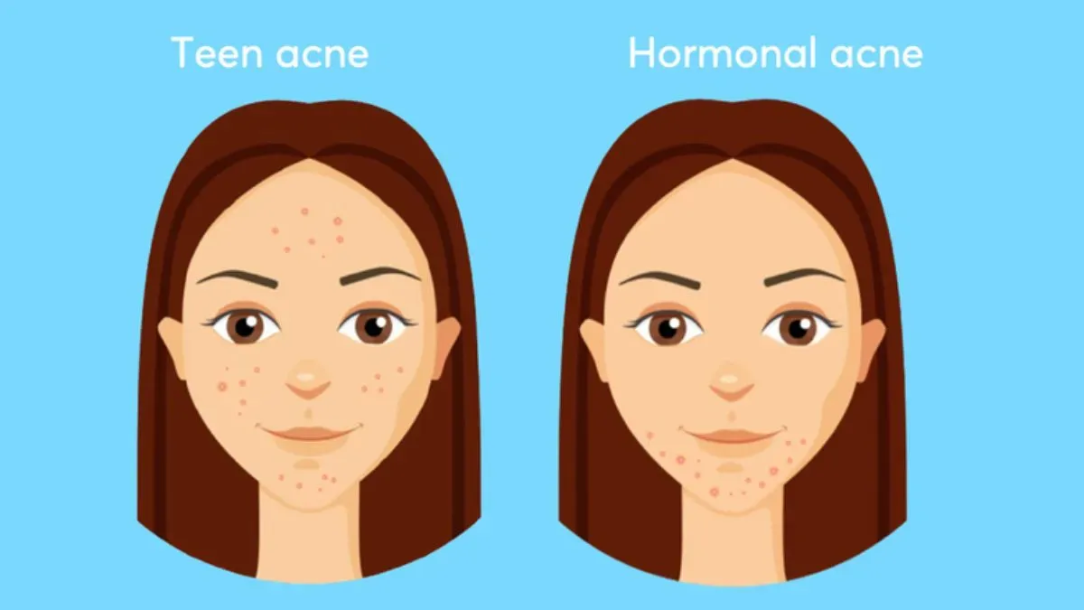 hormonal acne vs teen acne