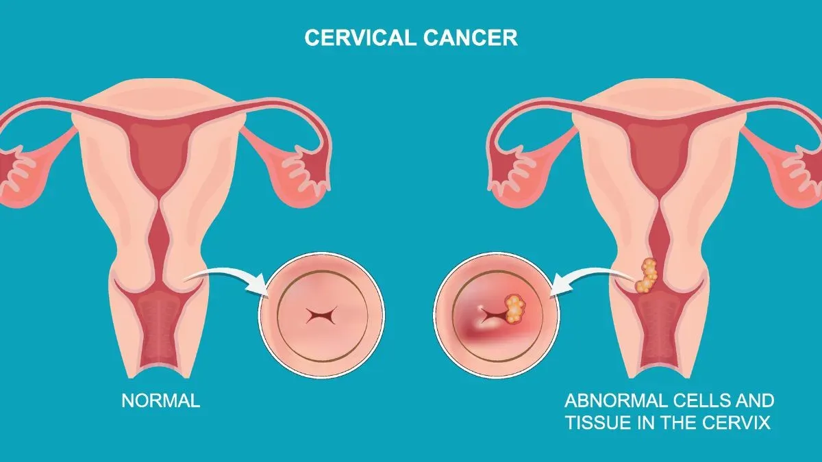 सर्विकल कैंसर दूसरा सबसे आम कैंसर है