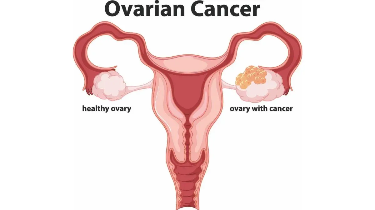 ovarian cancer