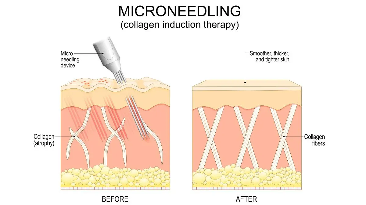 microneedling
