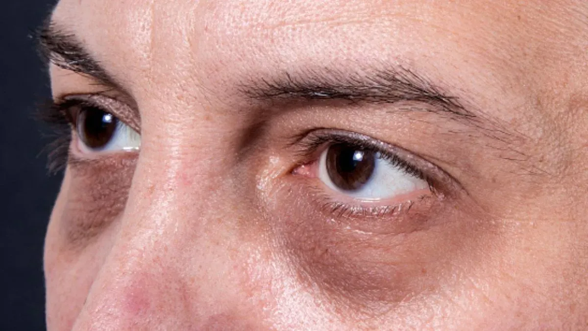 dark circles