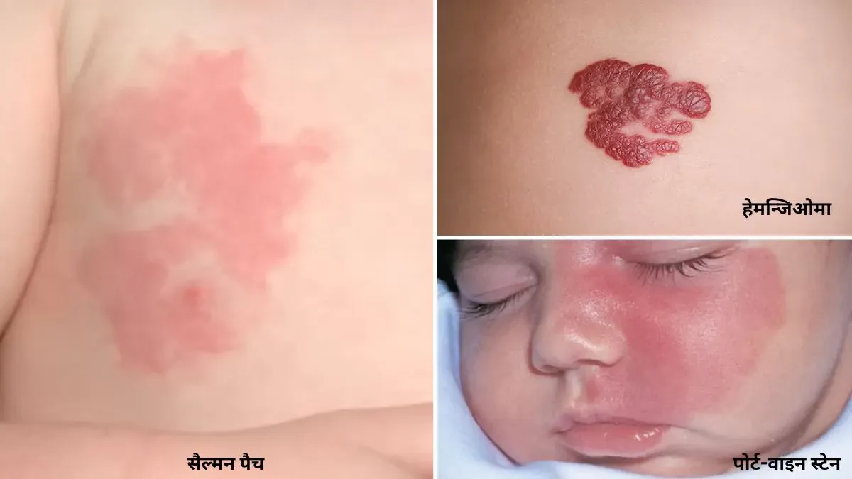 vascular birthmark