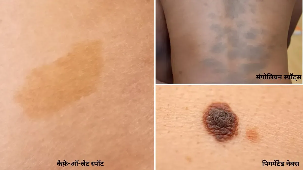 pigmented birthmark