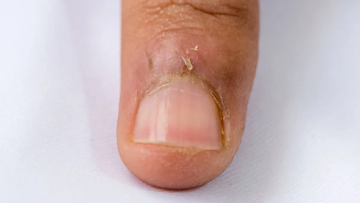 hangnail