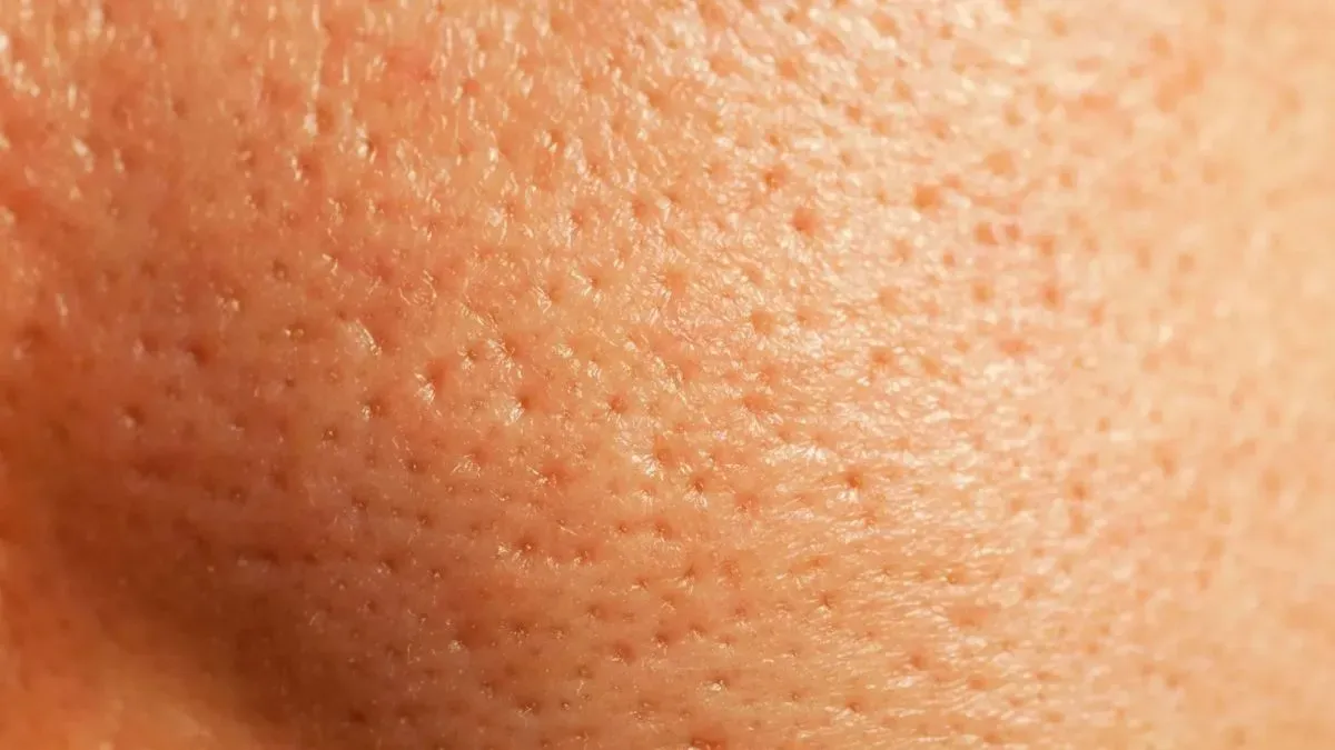 open pores