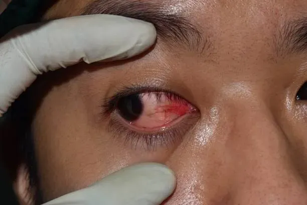 eye problem