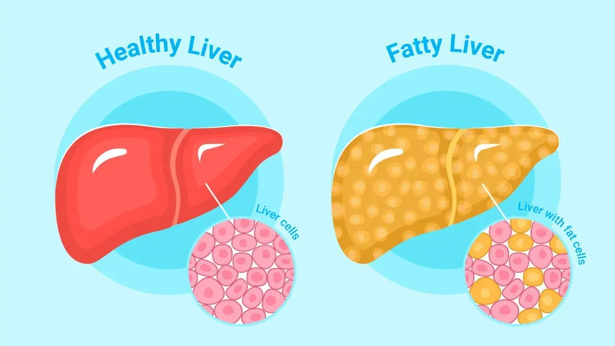 fatty liver