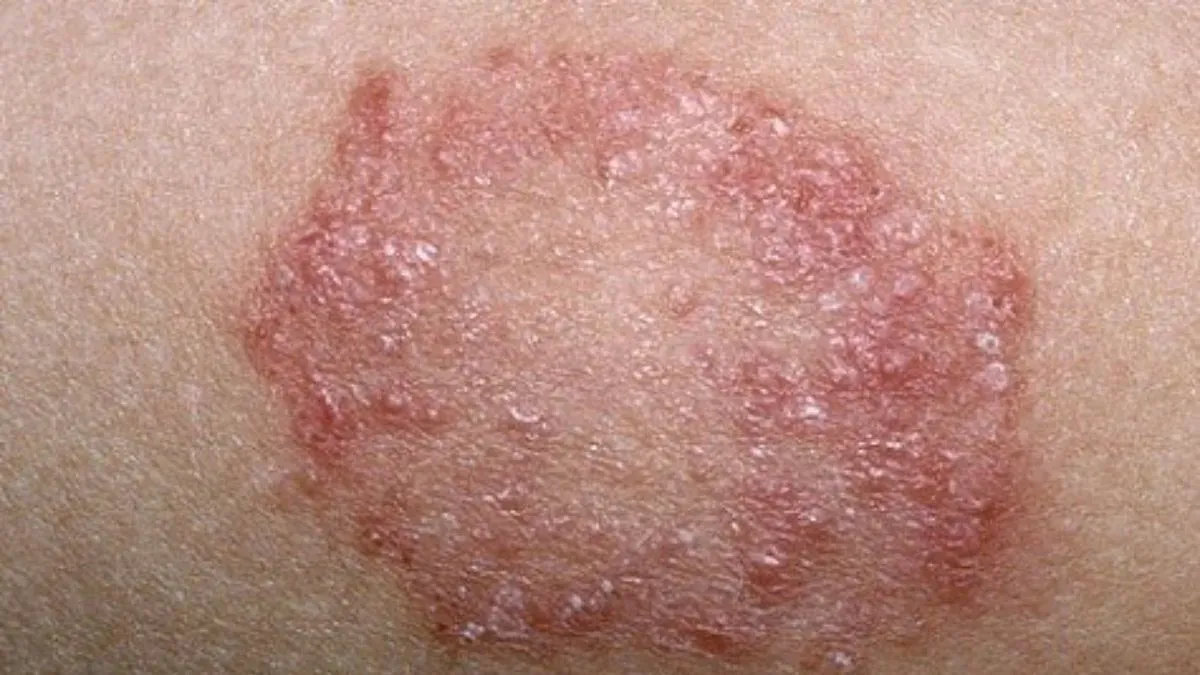 fungal infection