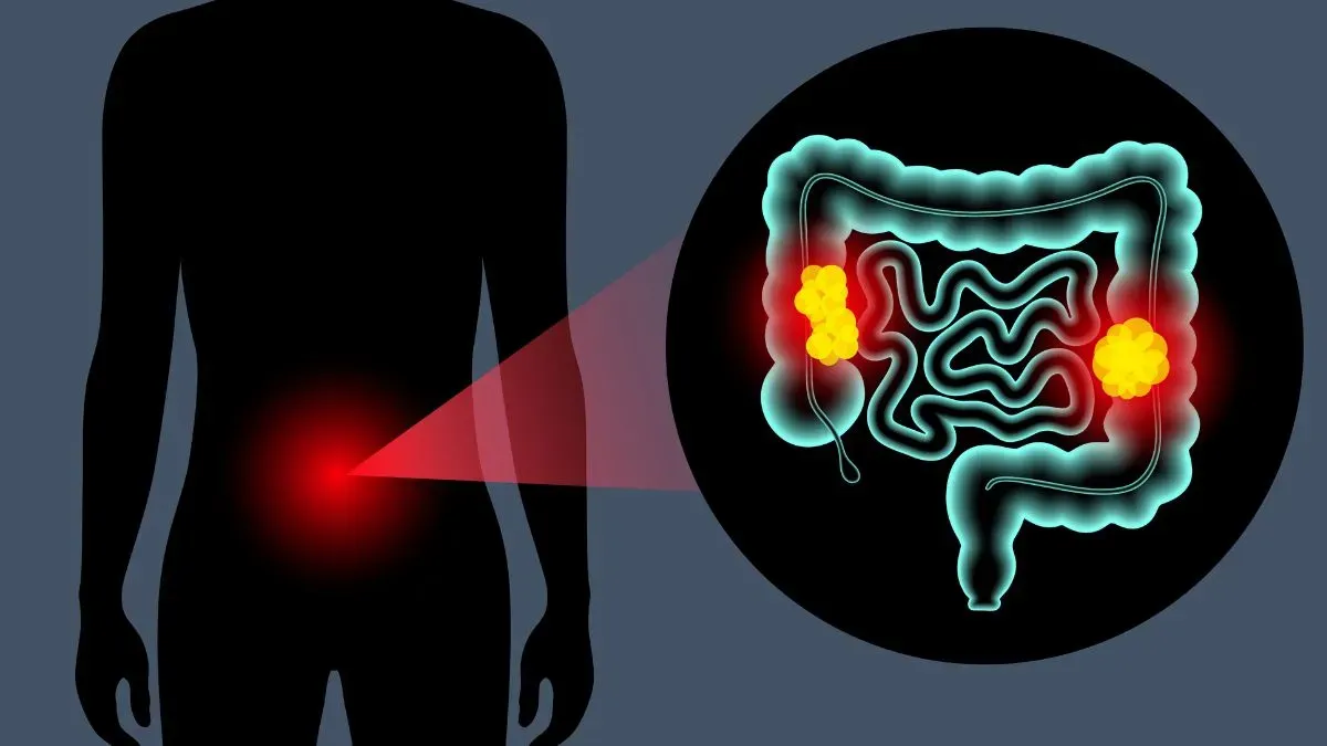 colon cancer