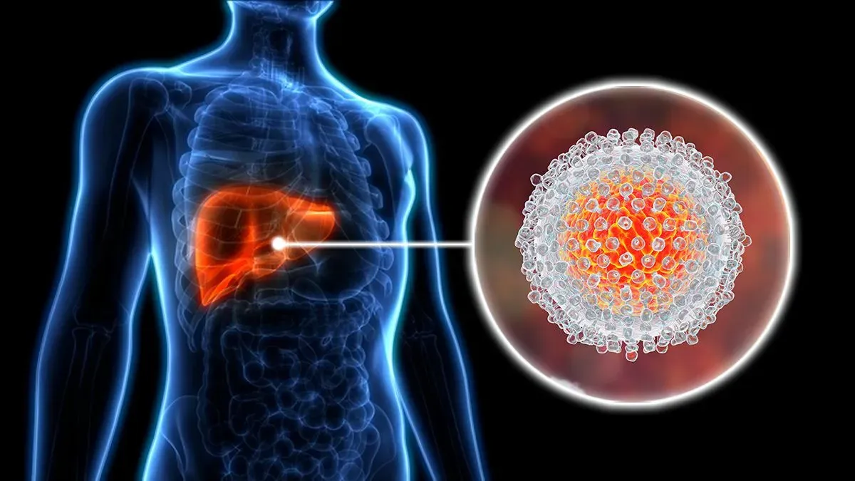 hepatitis 