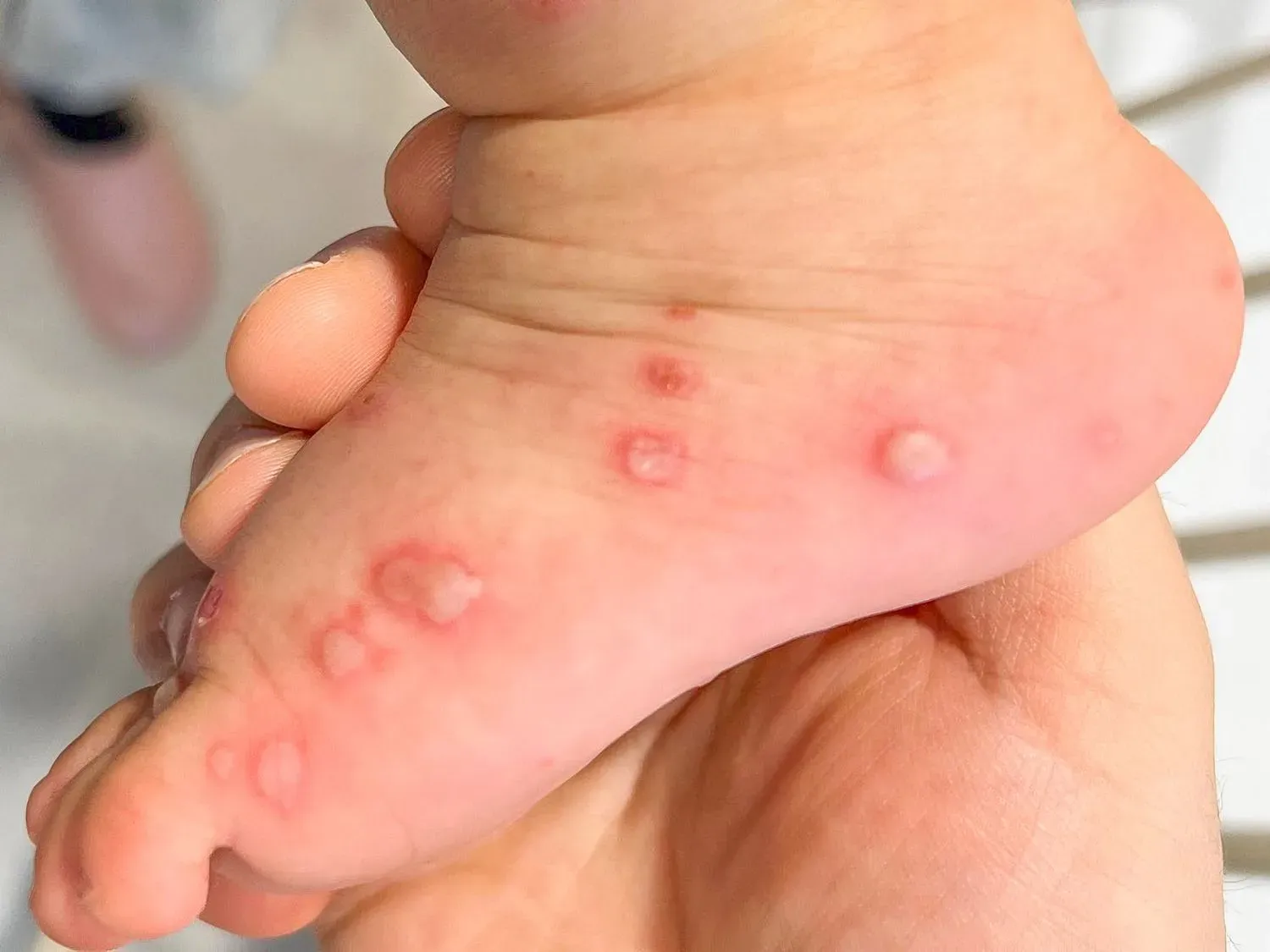 hand foot and mouth disease