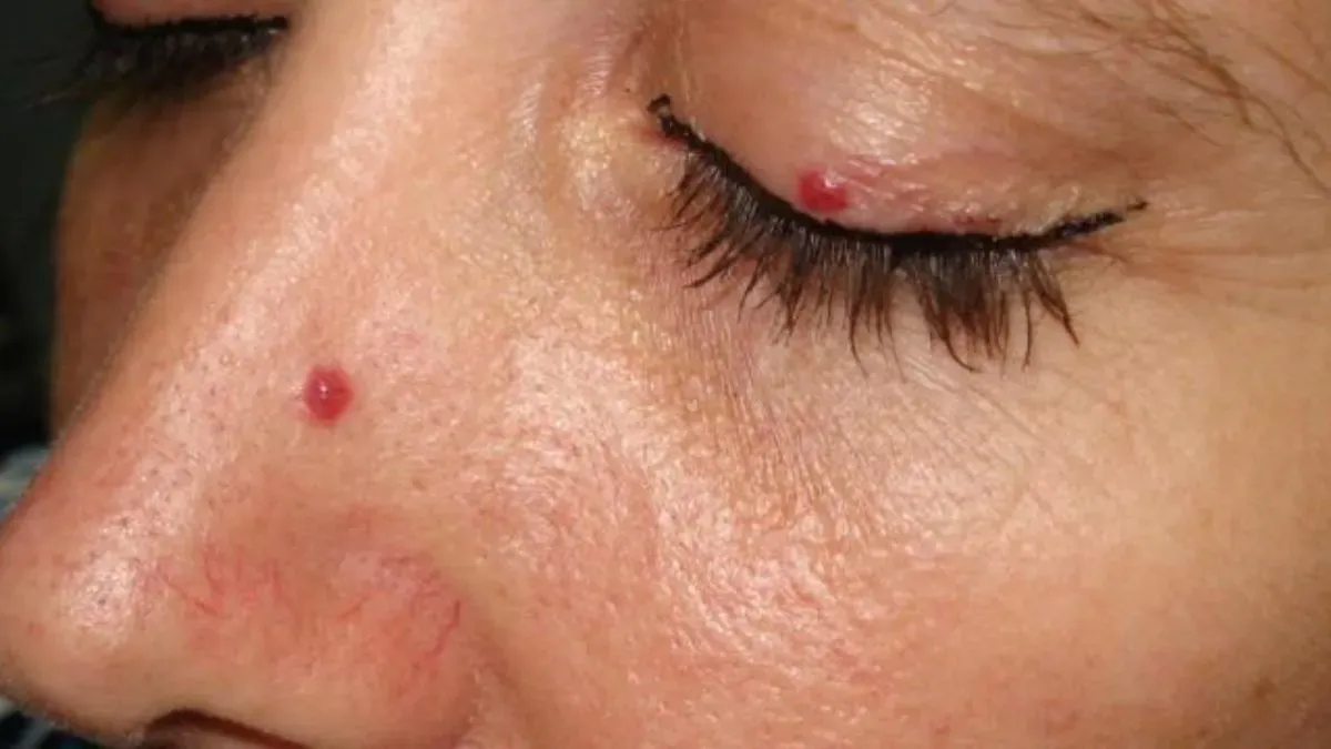 cherry angioma