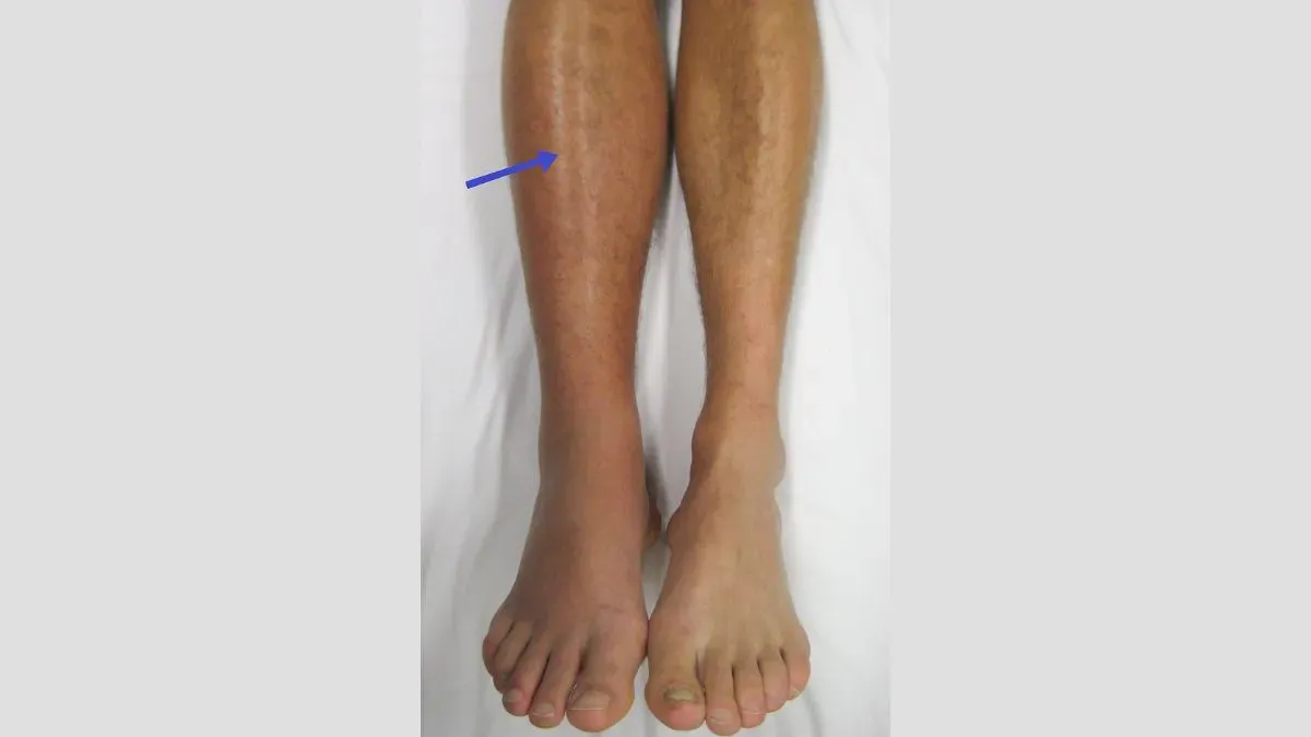 dvt