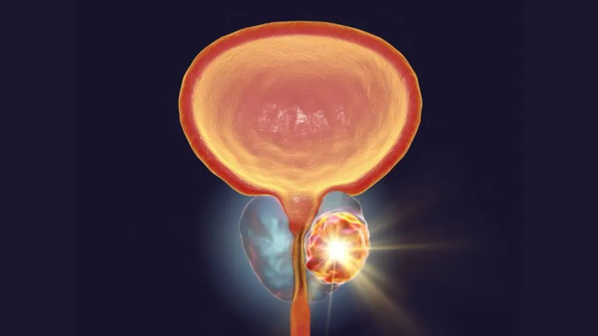 prostate cancer
