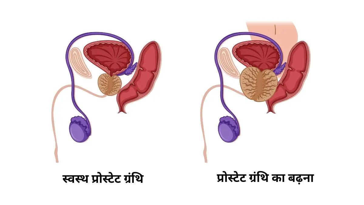 prostate gland