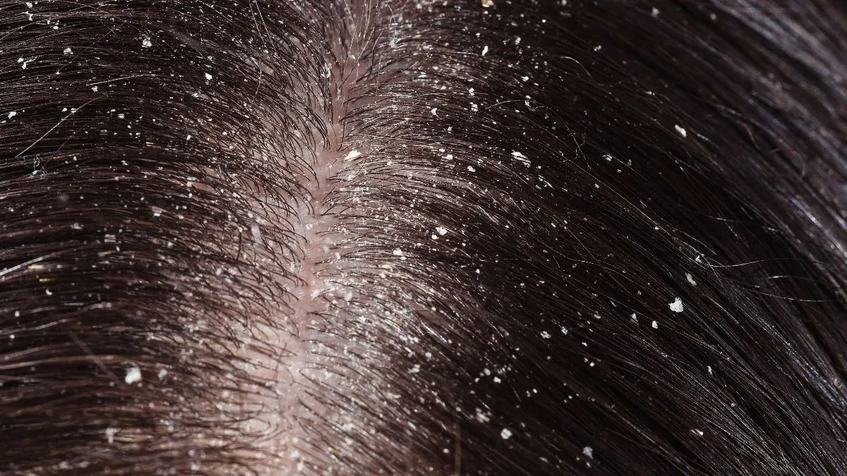 dandruff