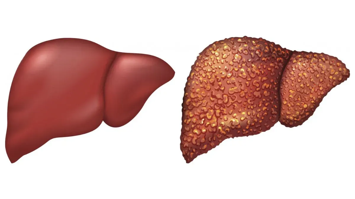liver fibrosis
