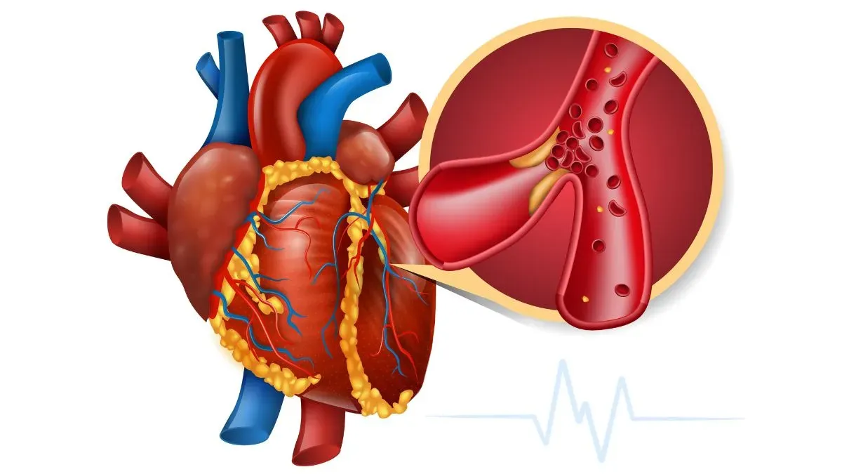 coronary artery disease