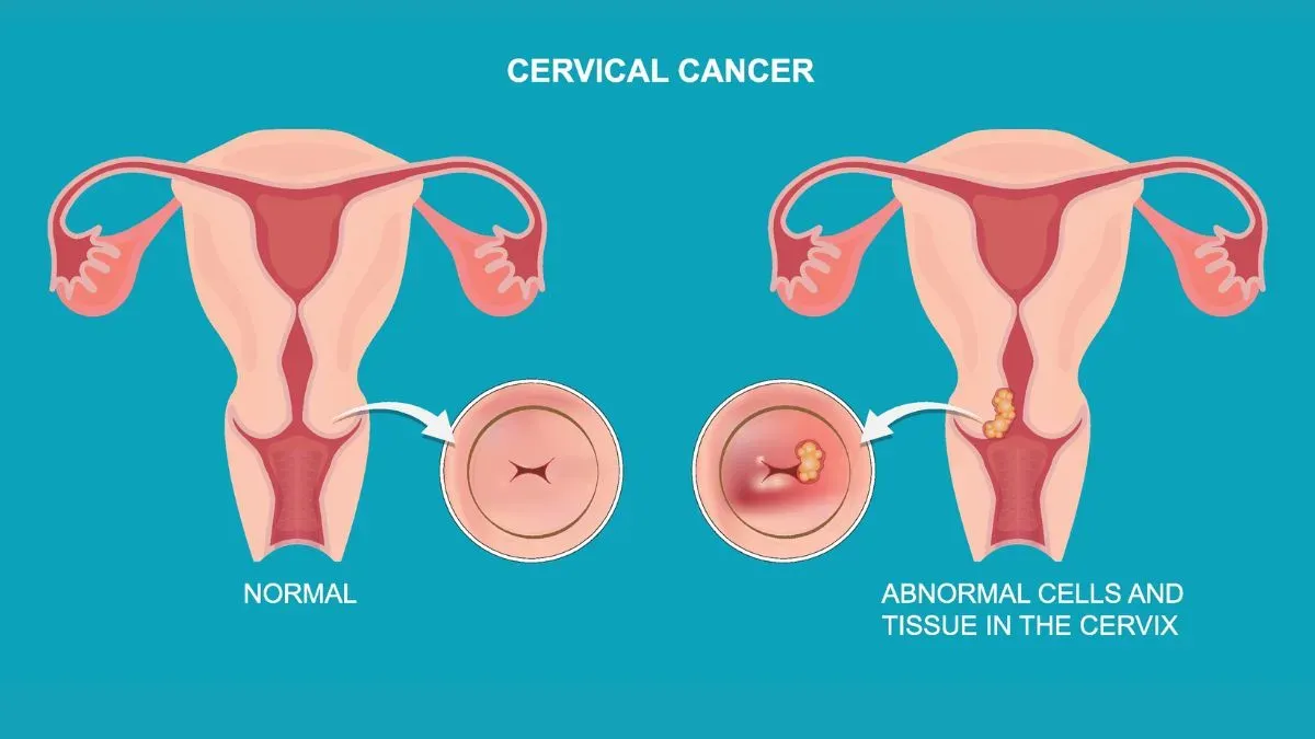 cervical cancer