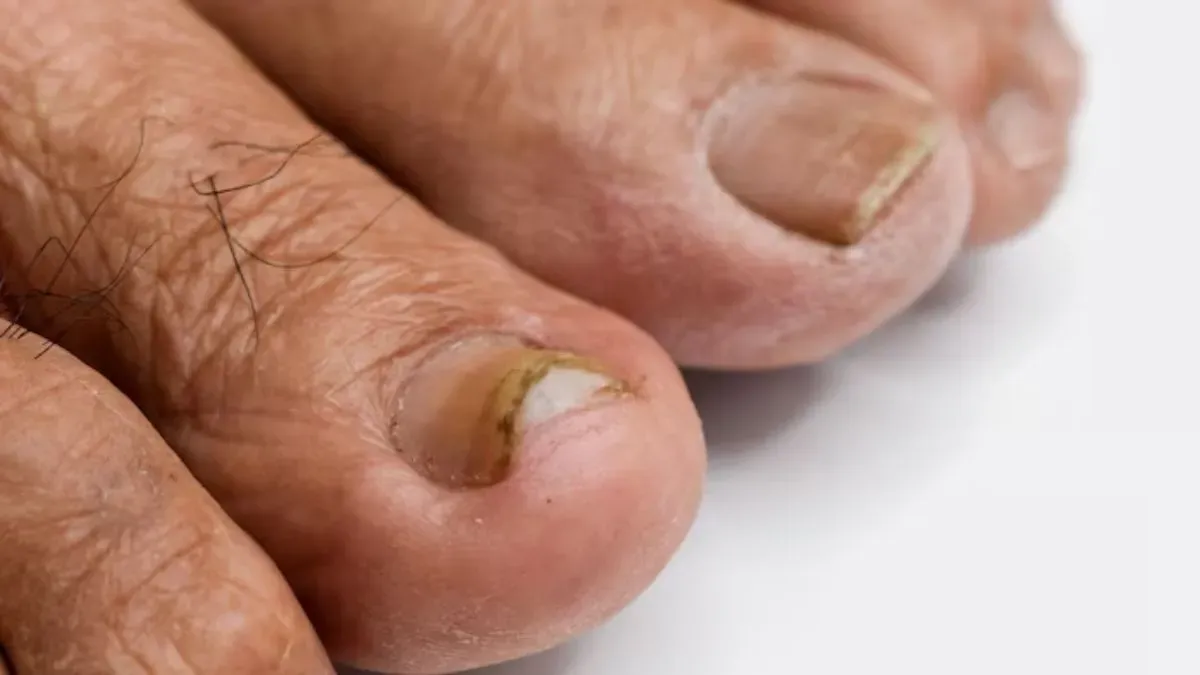 fungal nail infection