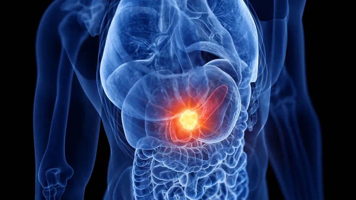 pancreatic cancer