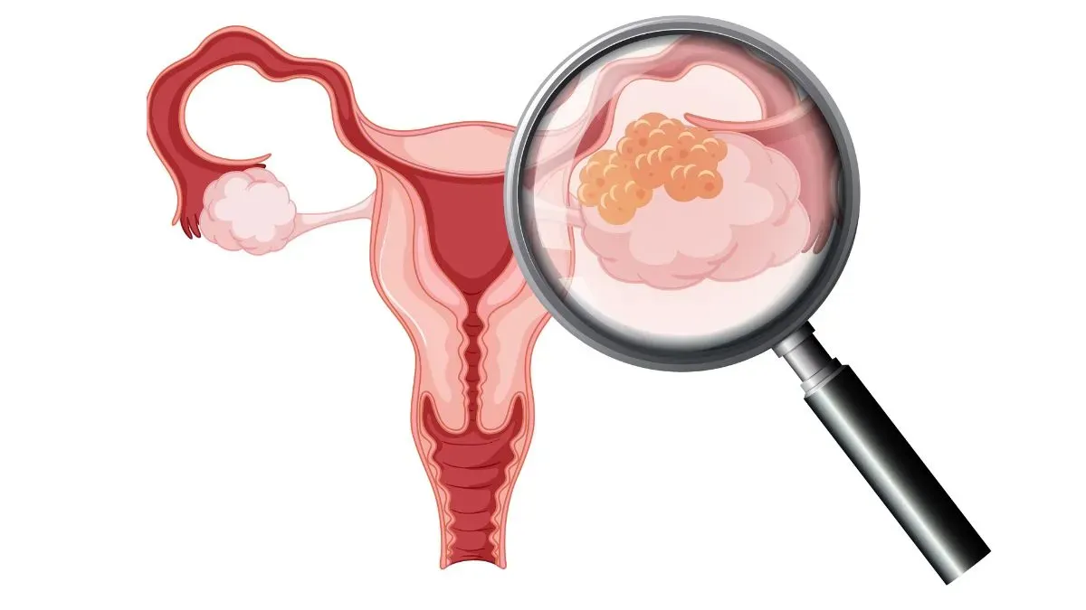 ovarian cancer