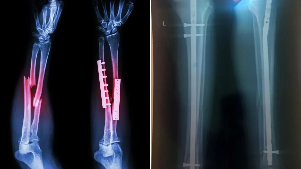 plate vs rod