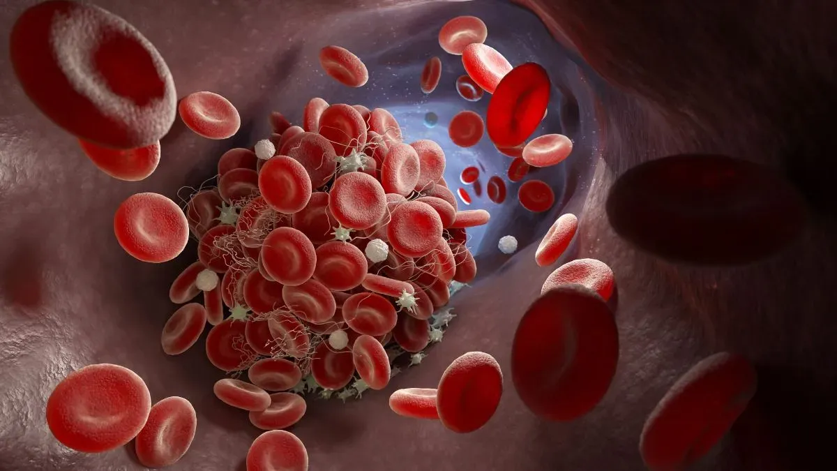 blood clot