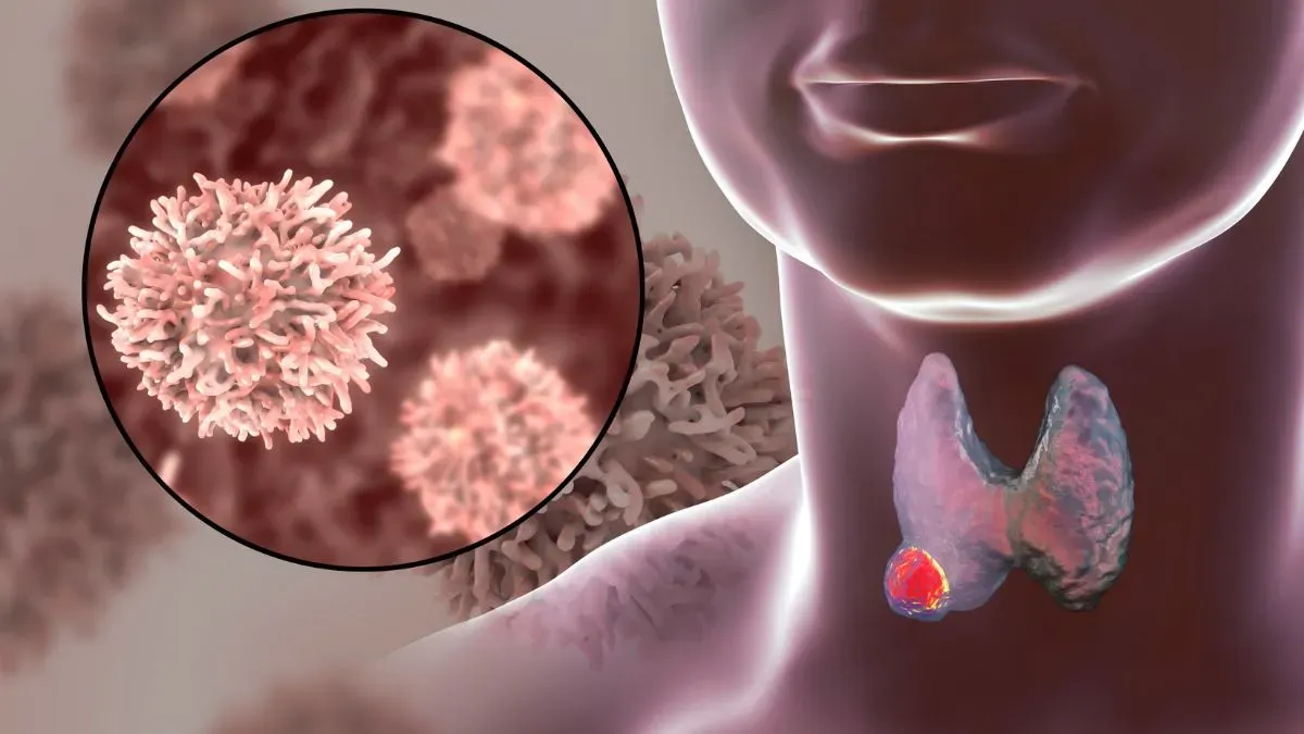 thyroid cancer