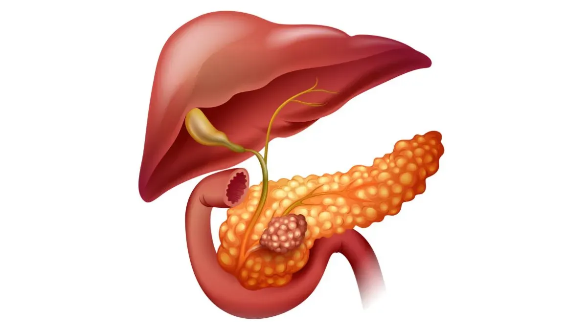 pancreatic cancer