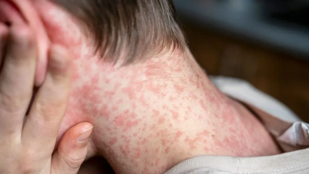 measles rash