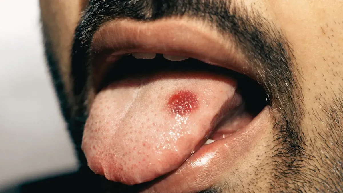 tongue cancer