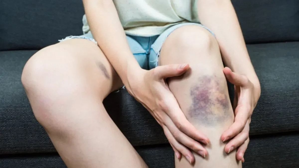 bruises