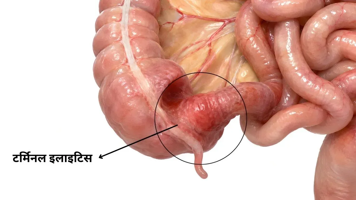 terminal ileum