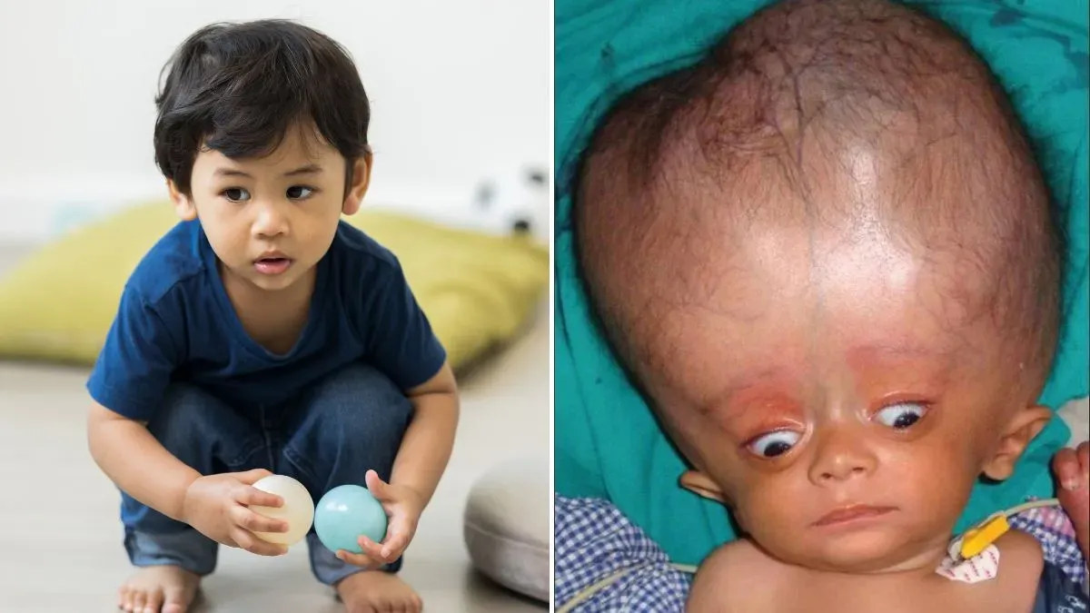 hydrocephalus