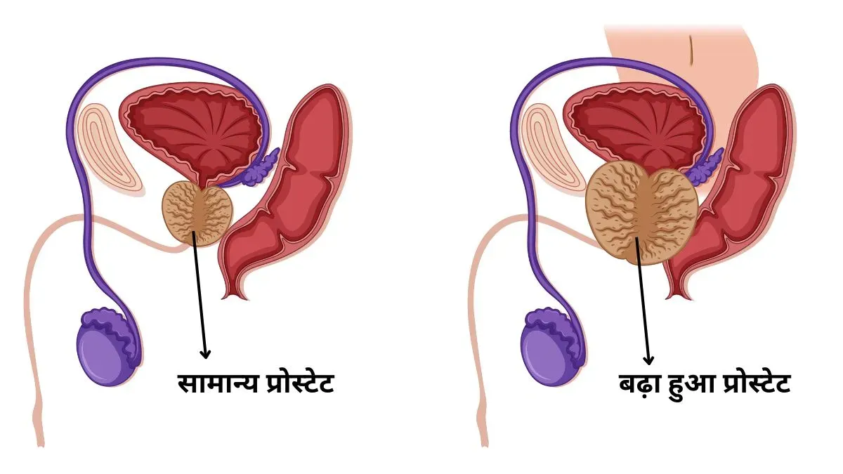 prostate