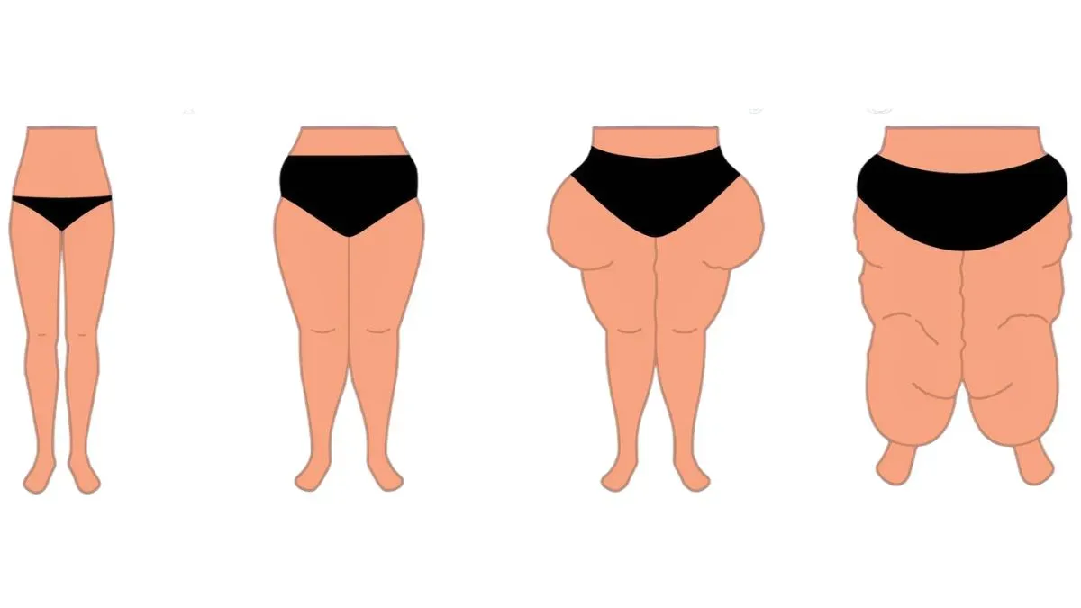lipedema